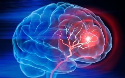 Sau cơn thiếu máu não thoáng qua, 72 giờ đầu cần làm gì để tránh đột quỵ não?