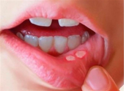 Phân biệt nhiệt miệng và ung thư lưỡi: Cách nhận biết sớm căn bệnh nguy hiểm