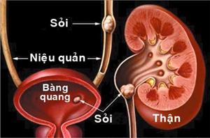 Những dấu hiệu bệnh sỏi thận khiến nhiều người nhầm lẫn