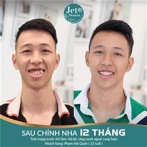 Nha khoa thẩm mỹ Jet Dentist: Niềng răng mắc cài sứ là gì?