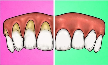 4 dấu hiệu cảnh báo bạn đang đánh răng quá kỹ và cách khắc phục để giữ răng khỏe