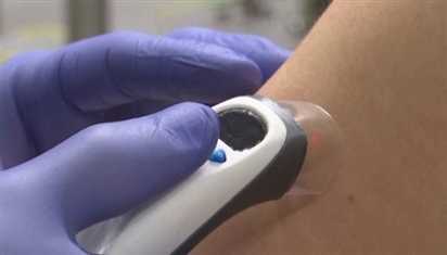 Công nghệ tia laser tiêm vaccine không đau đớn