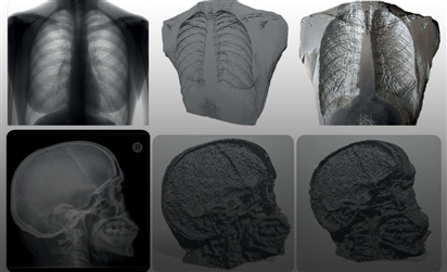 Mô hình Phantom nhôm hình người (anthropomorphic) độc đáo cho chụp X-quang kỹ thuật số lồng ngực